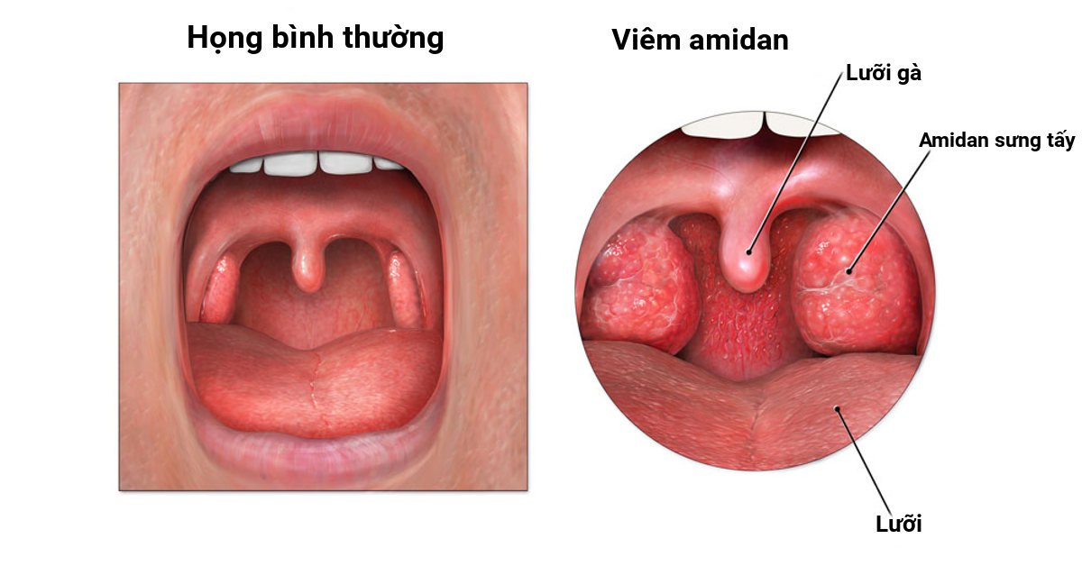 Amidan 2 bên sung đỏ là triệu chứng viêm họng cấp do vi khuẩn